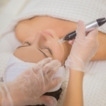 Biaya Laser Wajah Bopeng di 7 Klinik Kecantikan Terbaik