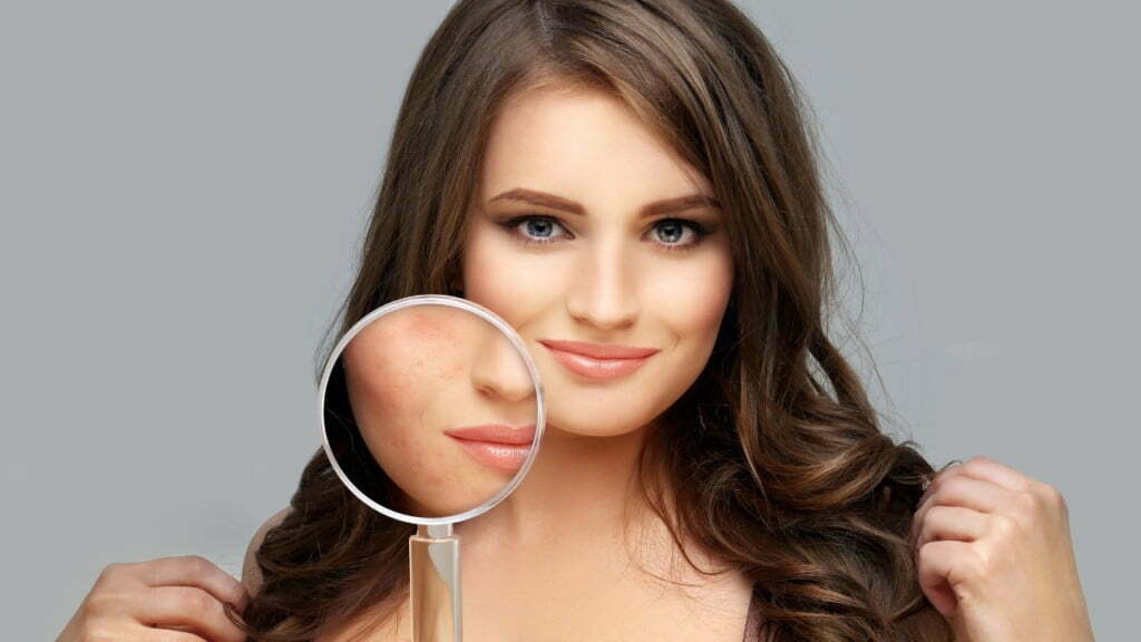 Pakai MS Glow Acne Malah Jerawatan? Ini Solusinya