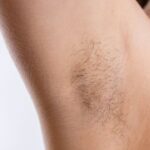 Ada beberapa gejala ingrown hair di ketiak yang harus Anda ketahui. Apa saja? Simak informasinya pada artikel berikut ini!