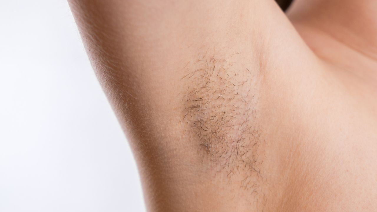Gejala Ingrown Hair di Ketiak Serta Cara untuk Mencegahnya