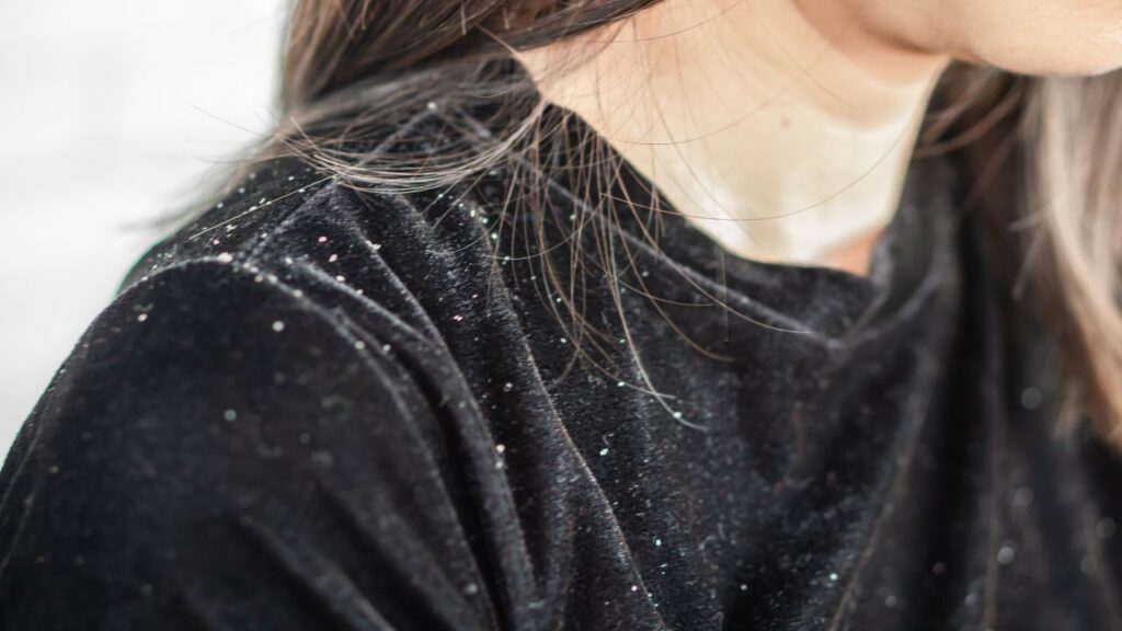 7 Cara Mengatasi Ketombe Membandel Secara Ampuh!