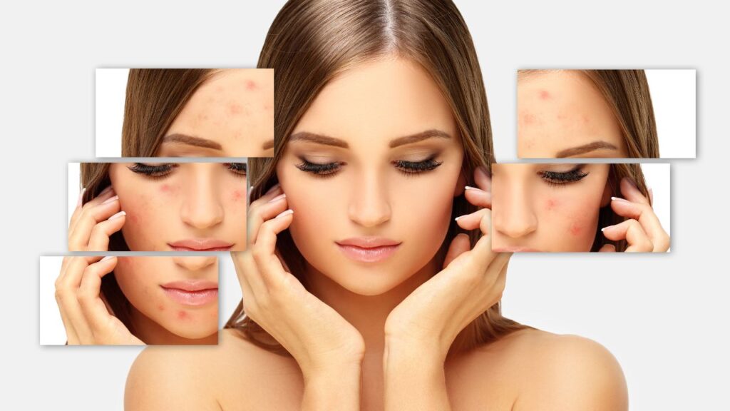 Mitos dan Fakta Seputar Jerawat: Memahami Kebenaran di Balik Masalah Kulit