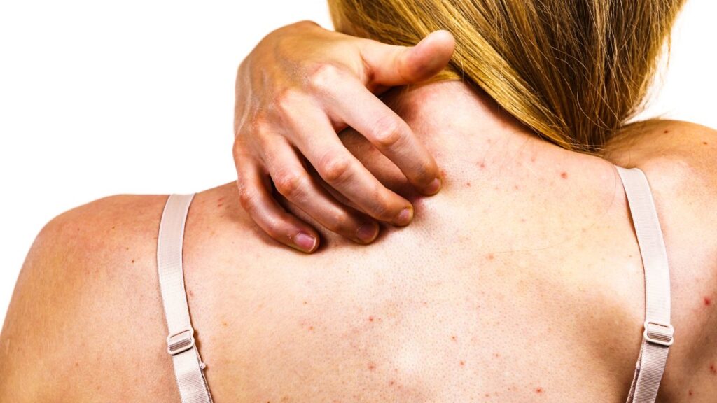 8 Cara Mengatasi Jerawat Punggung: Tips Sederhana untuk Kulit Lebih Sehat