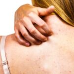 8 Cara Mengatasi Jerawat Punggung: Tips Sederhana untuk Kulit Lebih Sehat