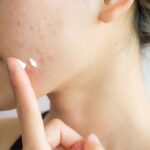 Apa Itu Tretinoin? Ini Dia Pengertian Beberapa Manfaatnya!