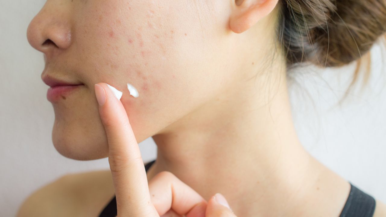 Apa Itu Tretinoin? Ini Dia Pengertian Beberapa Manfaatnya!