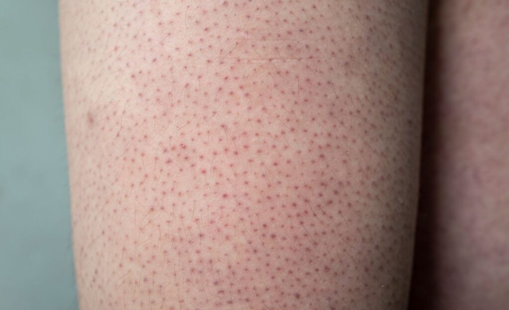 Apa Itu Chicken Skin? Kenali Penyebab, Ciri-Ciri, dan Cara Mengatasinya