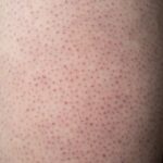Apa Itu Chicken Skin? Kenali Penyebab, Ciri-Ciri, dan Cara Mengatasinya