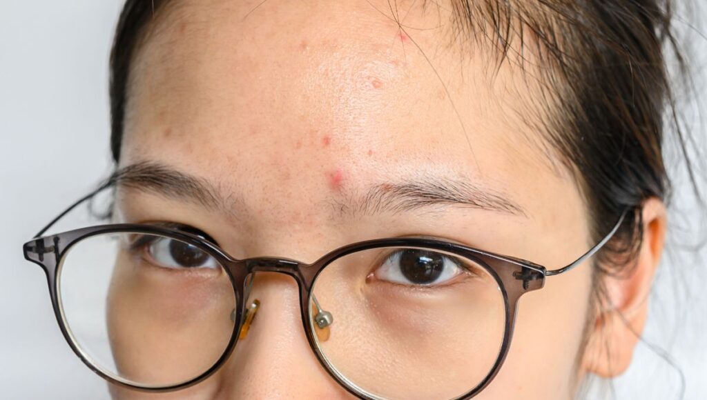 Jerawat di Dahi: Penyebab, Solusi, dan Arti Menurut Primbon