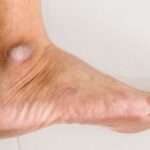 Mata Kaki Hitam: Penyebab, Cara Mengatasi, dan Cara Mencegah