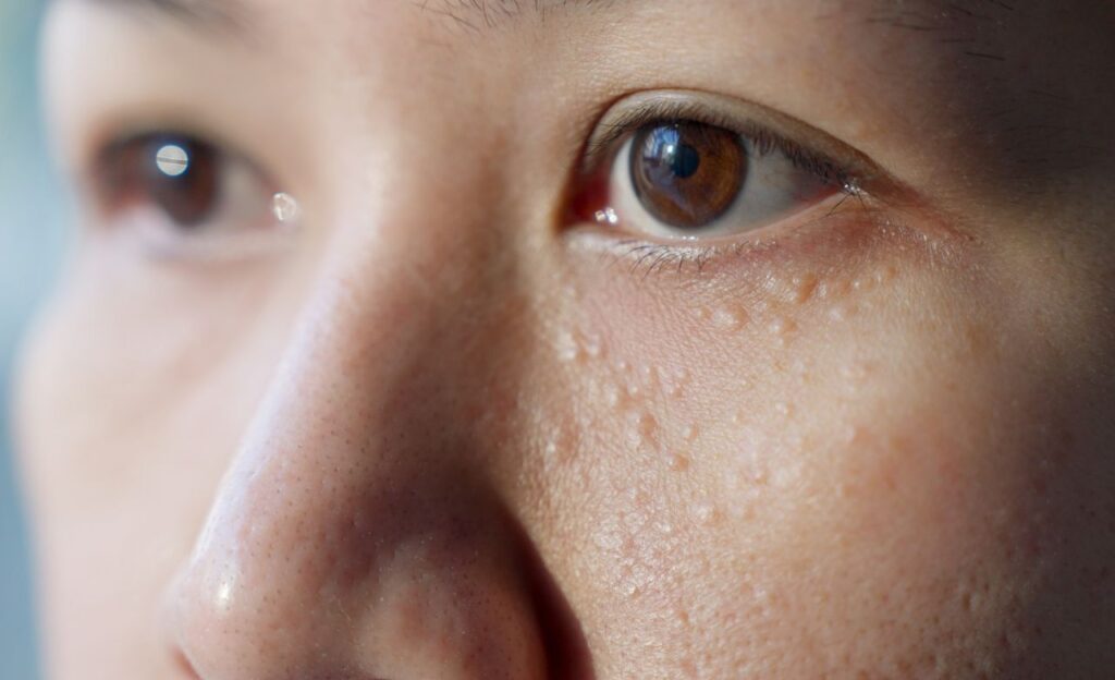 Mirip dengan Jerawat, Ini Arti Milia dan Cara Mengobatinya!