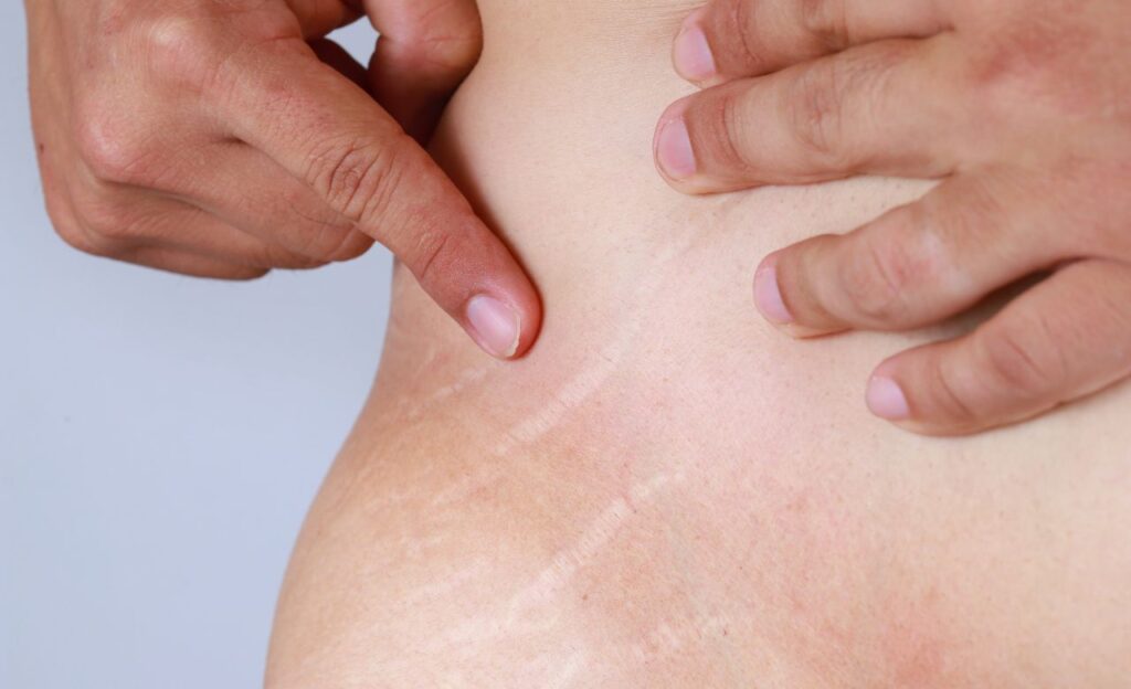 Ini Perbedaan Selulit dan Stretch Mark Menurut Dokter!