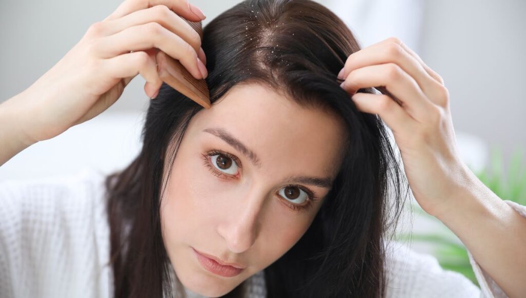 Apakah Ketombe Menular? Ini Penyebab dan Cara Mengatasinya!