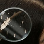 7 Cara Menghilangkan Kutu Rambut yang Efektif dan Ampuh