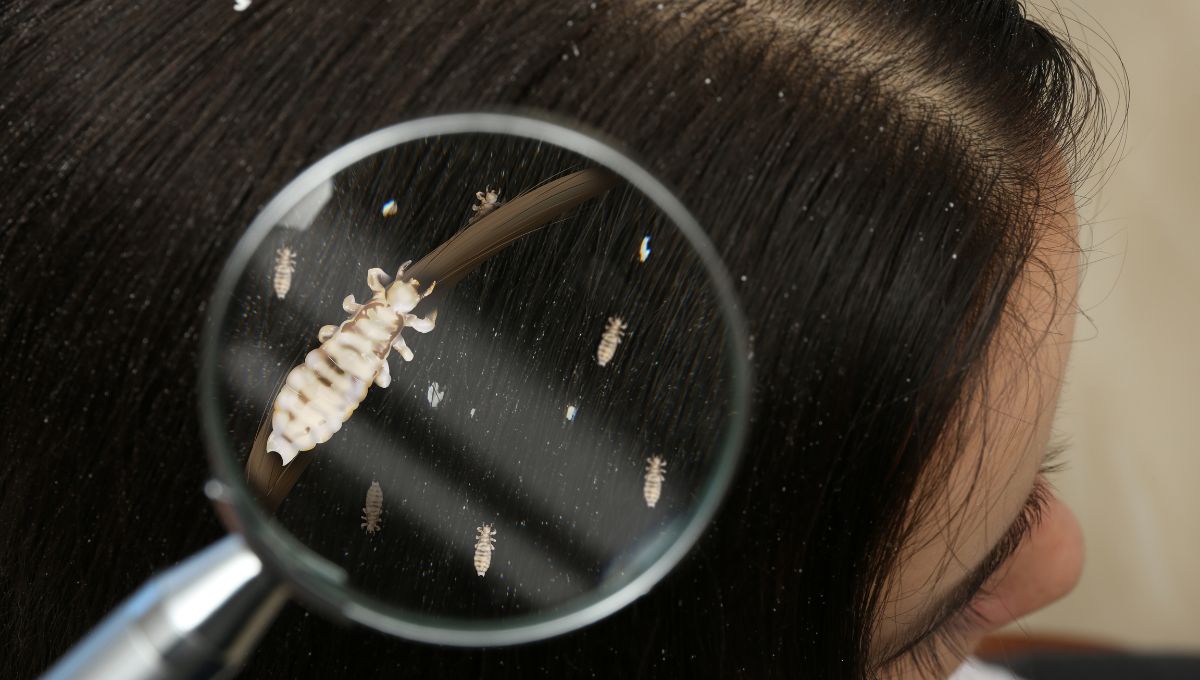 7 Cara Menghilangkan Kutu Rambut yang Efektif dan Ampuh
