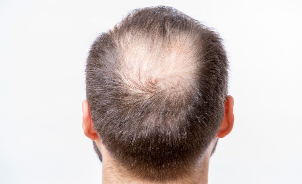 9 Penyebab Rambut Rontok pada Pria, Bisa Karena Stres, Lho!