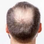 9 Penyebab Rambut Rontok pada Pria, Bisa Karena Stres, Lho!