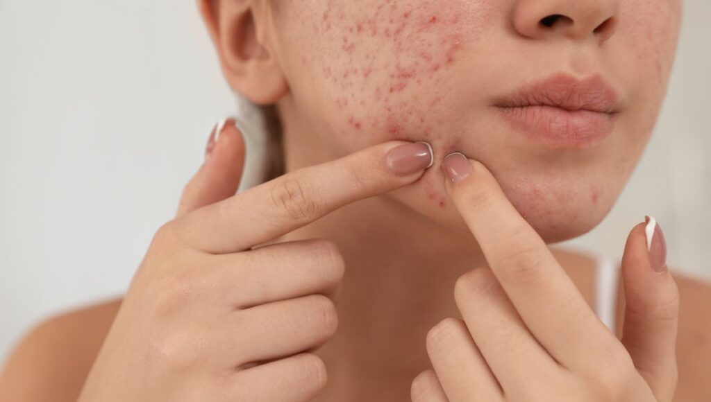 Mengenal Infeksi Jamur Fungal Acne dan Cara Mengatasinya