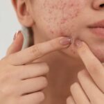 Mengenal Infeksi Jamur Fungal Acne dan Cara Mengatasinya