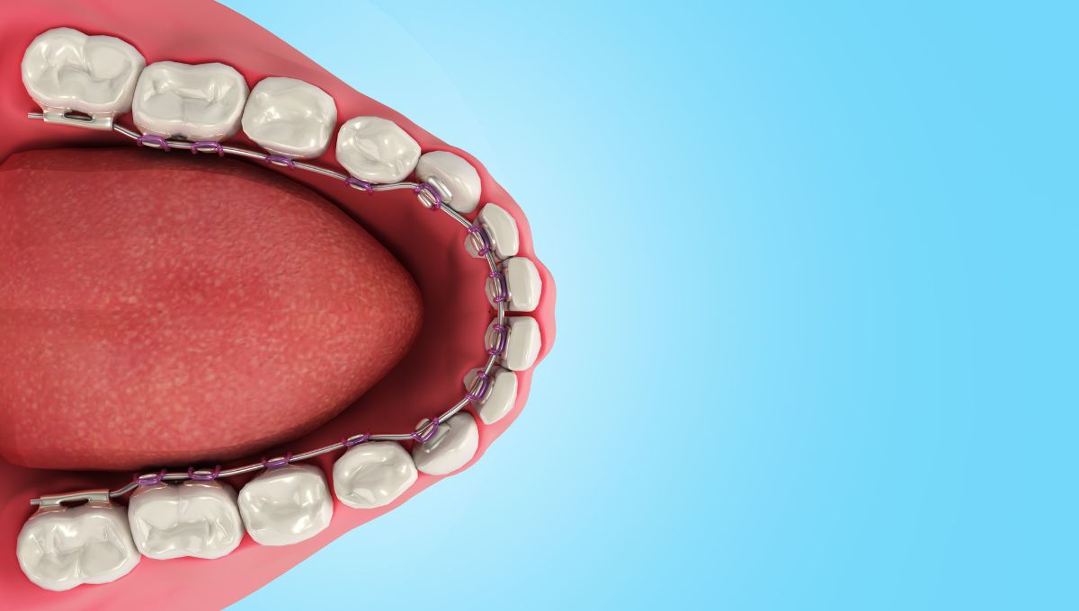 Lingual-Braces 2. Lingual Braces