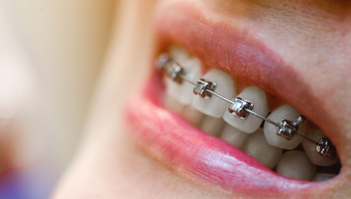 Self-ligating-Braces Self-ligating Braces