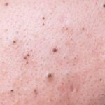 Blackhead atau Komedo Hitam, Ini Penyebab dan Cara Mengatasinya