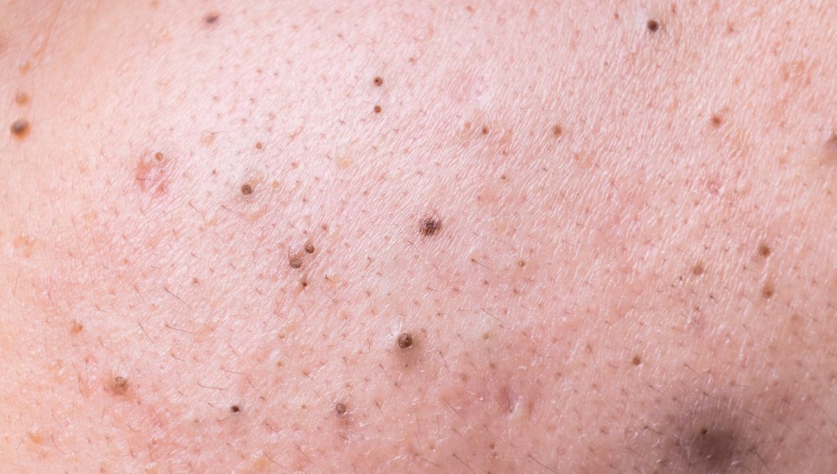 Blackhead atau Komedo Hitam, Ini Penyebab dan Cara Mengatasinya