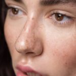 Ketahui Perbedaan Freckles, Melasma, dan Flek Hitam
