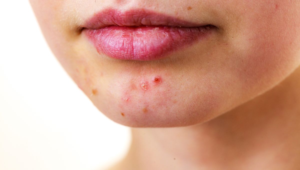 Jerawat di Bibir? Simak 9 Cara Mengatasinya dengan Mudah!